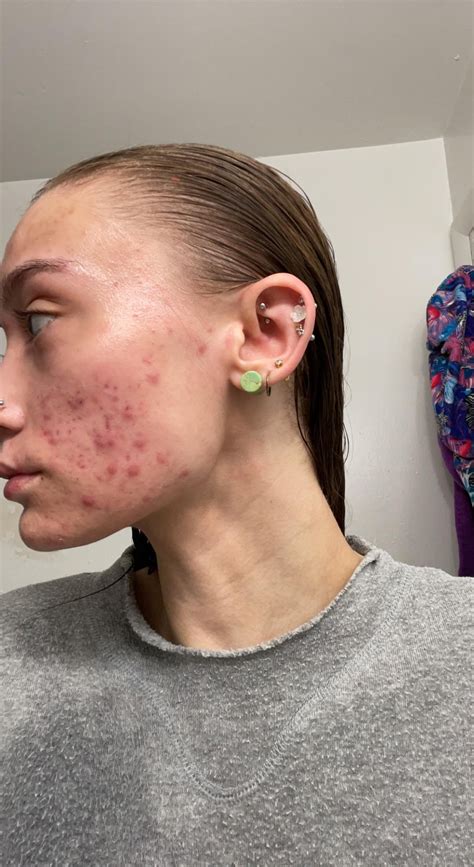 Another Differin gel update! A lot of healing and purging. : r/acne