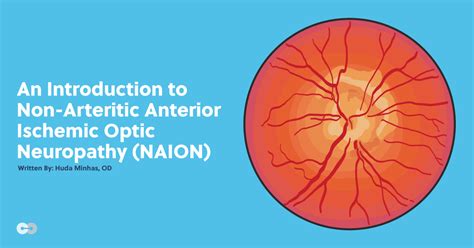 An Introduction to Non-Arteritic Anterior Ischemic Optic Neuropathy (NAION)