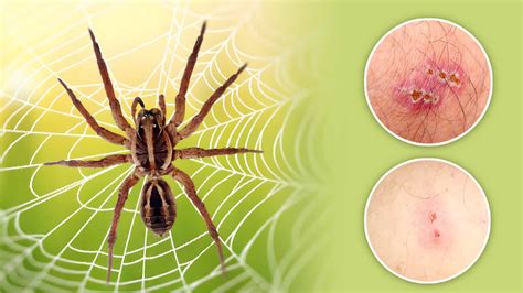 Spider Bite Identification Chart: A Step-by-Step Guide