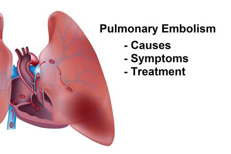 Pulmonary Embolism (Blood Clot In Lung) Causes, Signs And Symptoms, Test And Treatment | Health ...