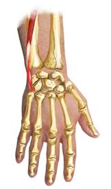 Extensor Carpi Ulnaris Tendonitis