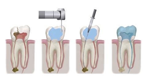 Brooklyn, NY Root Canal Procedure - Endodontic Treatment Step by Step