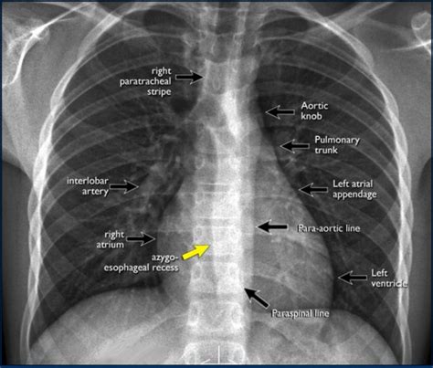 Normal Chest Xray Labeled