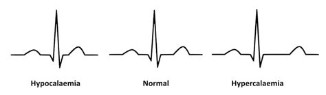 Paediatric ECG Interpretation • LITFL Medical Blog • ECG Library Basics