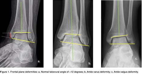 Varus Vs Valgus Fracture