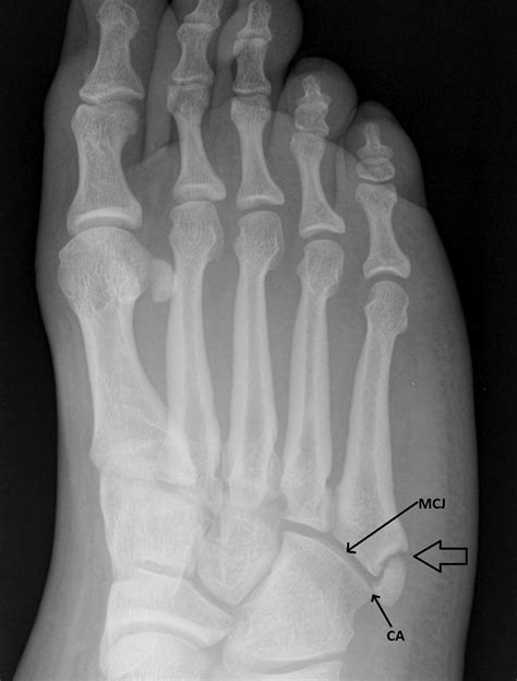 5th Metatarsal Growth Plate | Hot Sex Picture