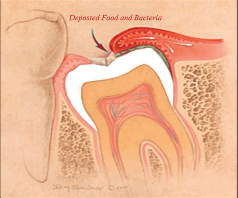 Wisdom Tooth Infection Diagnosis Pericoronitis, Prevention, Treatment