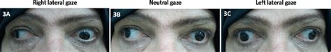 A-C: Wall-eyed bilateral internuclear ophthalmoplegia demonstrated by... | Download Scientific ...