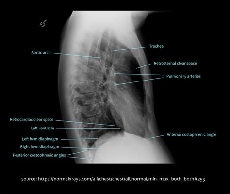 Lateral View Chest X Ray Anatomy