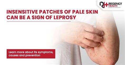 Leprosy (Hansen's Disease): Causes, Symptoms & Treatment