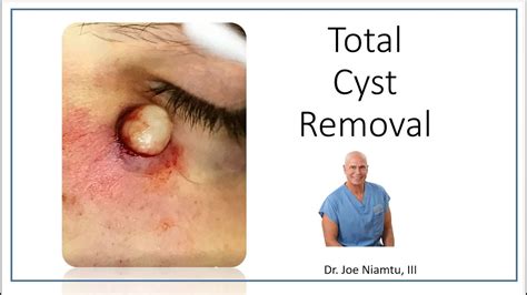 Sebaceous Cyst Face Removal