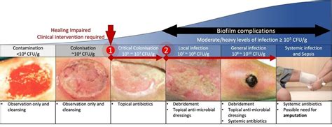 The wound infection continuum. Wound infections develop and progress as... | Download Scientific ...