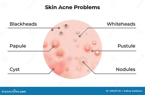 Skin Acne Types Diagram. Vector Skin Problems Disease, Pimples ...