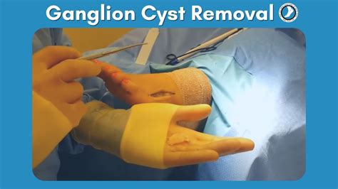 What Is A Ganglion Cyst Ganglion Cyst Removal Without Surgery Images | Porn Sex Picture