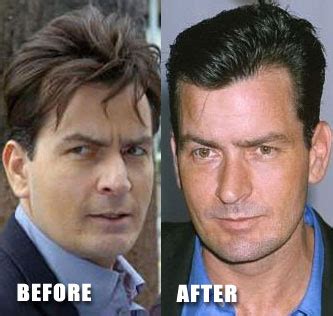 Charlie Sheen Nose Job Before After Photos