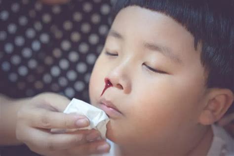 Nosebleeds in Children: Everything You Need to Know | Kids Clinic Singapore