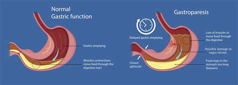 Gastroparesis Causes And Symptoms - PELAJARAN