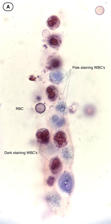 Urine Sediment of the Month: White Blood Cells, “Glitter Cells”, and WBC Casts - Renal Fellow ...