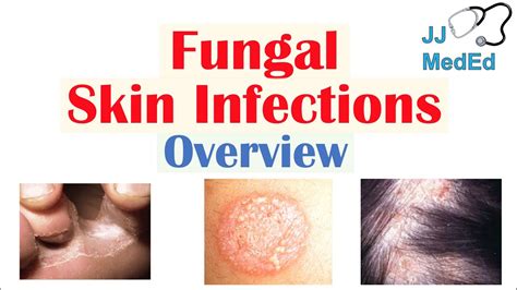 Fungal Skin Infection Hands