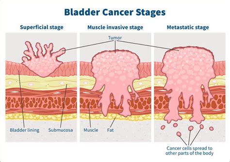 Bladder Cancer Survival: The Importance of Early Detection | Cxbladder