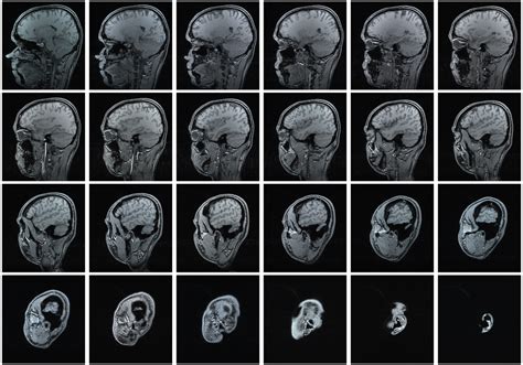 MRI With Contrast