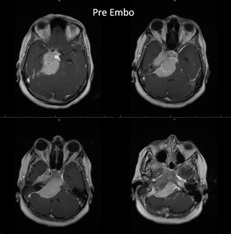 Case Archives Petroclival Meningioma MHT and ILT access | neuroangio.org