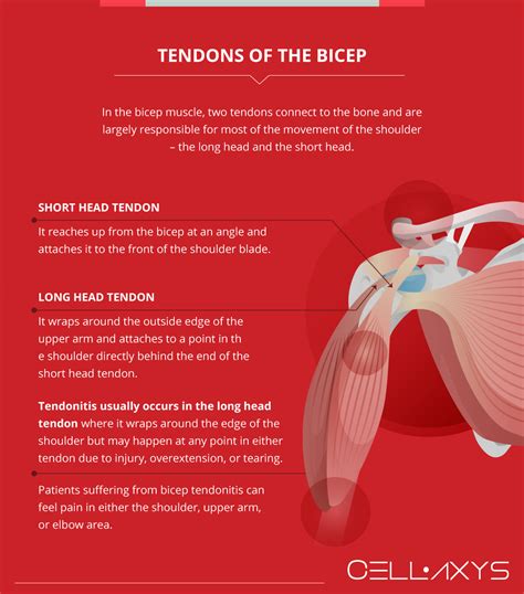 Bicep Tendonitis: Shoulder Pain And Treatment - Cellaxys