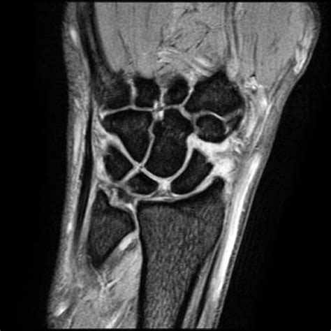 OrthoDx: Scapholunate Ligament Injury - Clinical Advisor