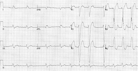 Left Bundle Branch Block (LBBB) • LITFL • ECG Library Diagnosis