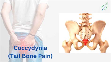 Say Goodbye to Tail Bone Pain | Coccydynia Treatment at Spinalogy Clinic | Best Back Pain, Slip ...