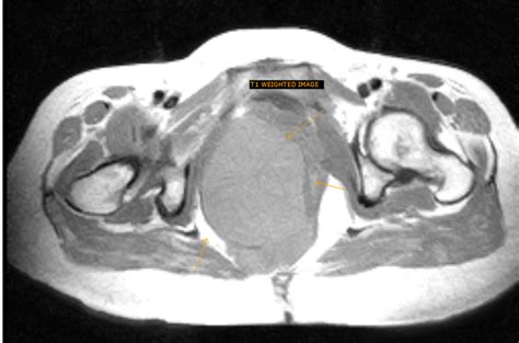 Perirectal Cyst-Differentials - Sumer's Radiology Blog