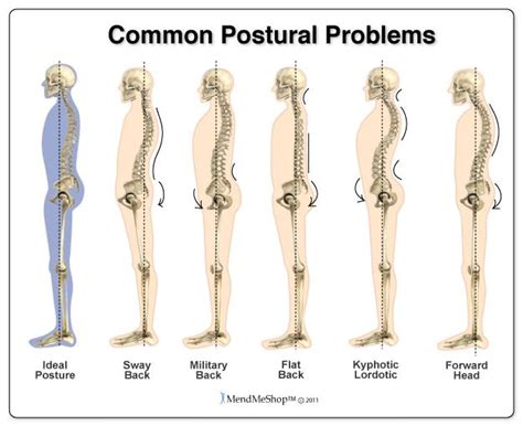 FLAT BACK AND SWAYBACK POSTURE | Improve posture, Back pain, Neck pain