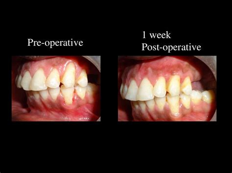 Mucogingival surgery