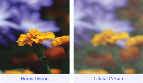 The Ins and Outs of Cataract Surgery | VisionFirst Eye Center