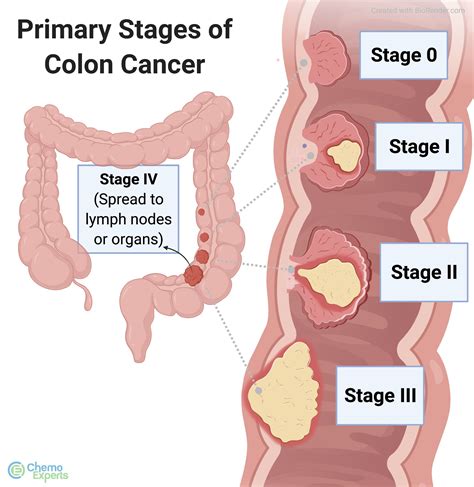 Colon Cancer treatment | ChemoExperts