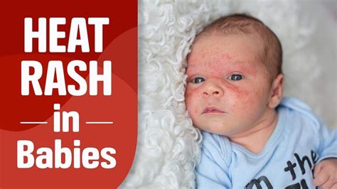 Heat Rash On Baby Back Pictures / Heat Rash On Babies - Causes, Symptoms And Treatment : 389 x ...