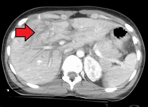 Liver injury - WikEM