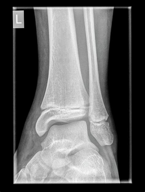 Ankle X-ray Photograph by Photostock-israel - Pixels