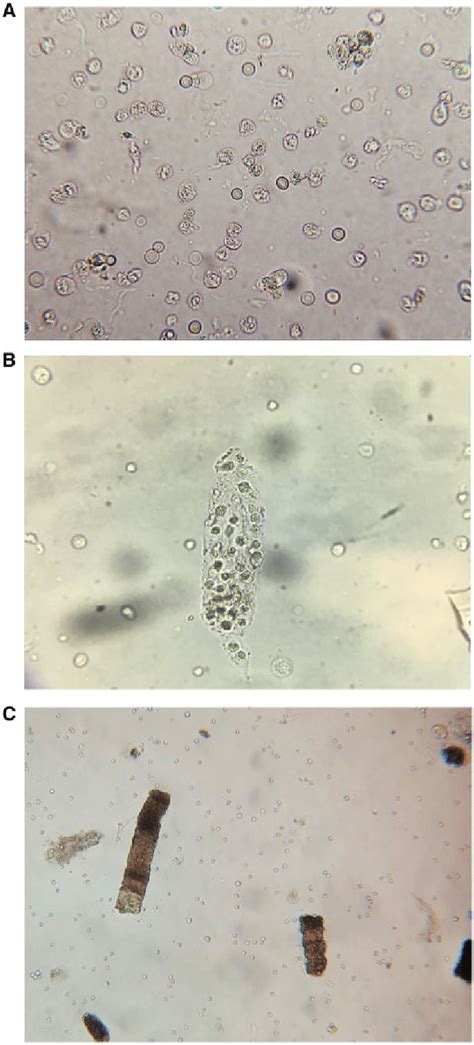 Urine microscopy findings in AIN. (A) WBCs and RBCs. (B) WBC cast. | Download Scientific Diagram