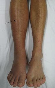 Oedema Assessment - Physiopedia