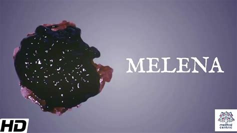 Melena, Causes, Signs and Symptoms, Diagnosis and Treatment - YouTube