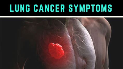 Stages Of Lung Cancer