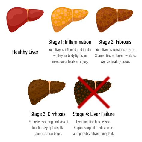 Liver Fibrosis Ultrasound