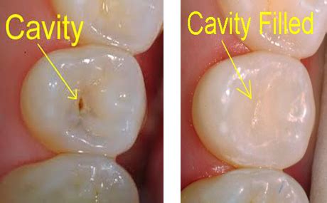 filling-cavity - Michael E. Krone, D.D.S. Family Dentistry