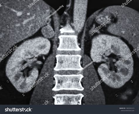 Contrast Enhanced Ct Scan Computed Tomography Stock Photo 1383391613 | Shutterstock