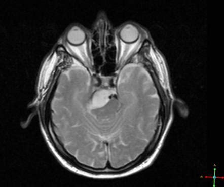 Petroclival meningioma | Radiology Case | Radiopaedia.org