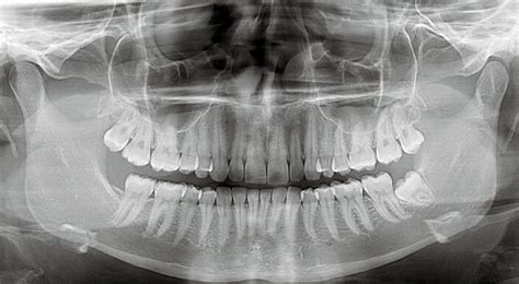 OPG X-Ray | Dental Scan Ltd