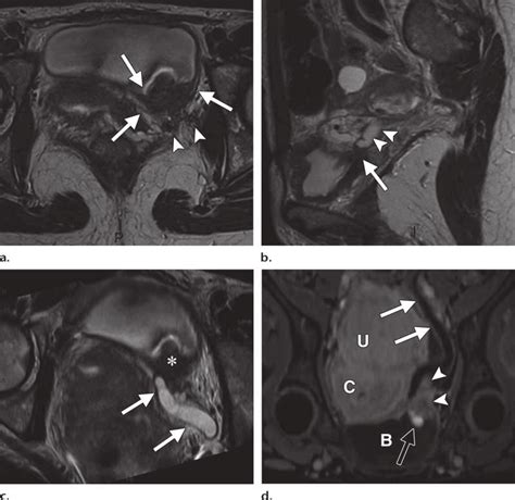 Bladder endometriosis with ureteral involvement in a 33-year-old woman ...