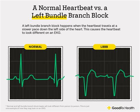 Left Bundle Branch Blocks on EKGs: Testing and Treatment - GoodRx