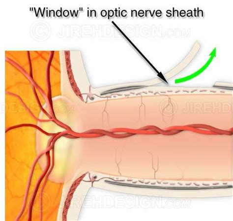 Optic nerve sheath surgery - #SUO0000 | Stock eye images